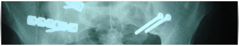 Pelvic Trauma Pain Fracture Banner